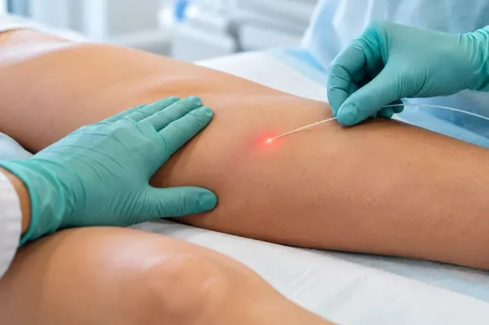 Tratamento a laser fecha a veia safena sem retirar a veia da perna